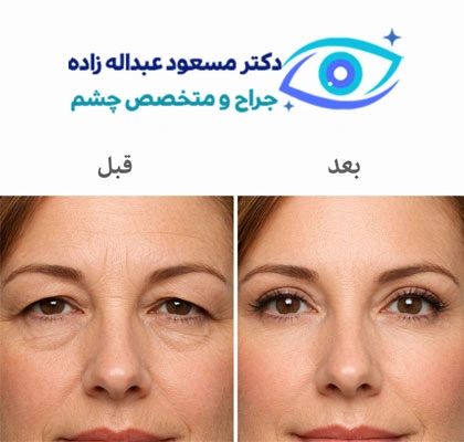 جراحی بلفاروپلاستی پلک بالا